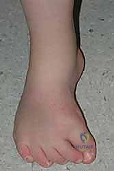 صورة توضيحية لـ نقل وتر الظنبوب الأمامي إلى العظم الإسفيني الوحشي حل متقدم للقدم الحنفاء المقاومة