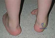 صورة توضيحية لـ نقل وتر الظنبوب الأمامي إلى العظم الإسفيني الوحشي حل متقدم للقدم الحنفاء المقاومة