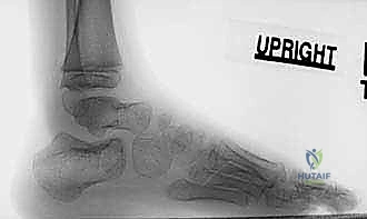 صورة توضيحية لـ نقل وتر الظنبوب الأمامي إلى العظم الإسفيني الوحشي حل متقدم للقدم الحنفاء المقاومة