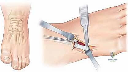 الشق الجراحي الأول للوصول للوتر