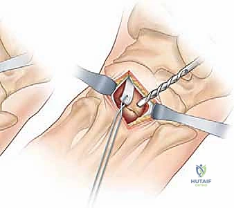 صورة طبية: نقل وتر الظنبوب الأمامي إلى العظم الإسفيني الوحشي حل متقدم للقدم الحنفاء المقاومة