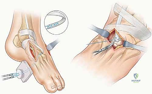 صورة طبية: نقل وتر الظنبوب الأمامي إلى العظم الإسفيني الوحشي حل متقدم للقدم الحنفاء المقاومة