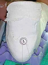 التخطيط ما قبل الجراحة وتحديد مسار الوتر