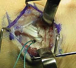 صورة طبية: نقل وتر الظنبوب الأمامي إلى العظم الإسفيني الوحشي حل متقدم للقدم الحنفاء المقاومة