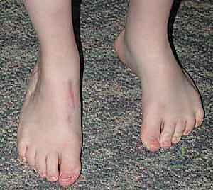 صورة توضيحية لـ نقل وتر الظنبوب الأمامي إلى العظم الإسفيني الوحشي حل متقدم للقدم الحنفاء المقاومة