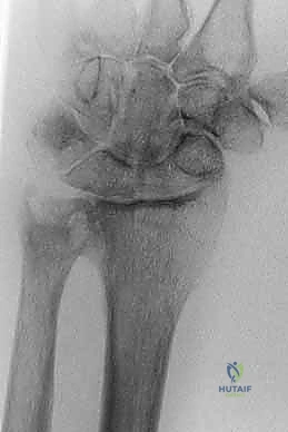 Sauvé-Kapandji Procedure: A Masterclass in Distal Radioulnar Joint Reconstruction
