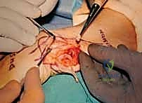 صورة توضيحية لـ عملية سوفيه-كاباندجي: حل متقدم لآلام وعدم استقرار مفصل الرسغ الزندي الكعبري