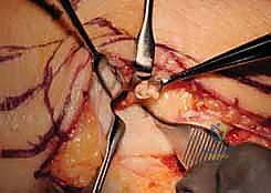 تشريح المفصل الزندي الكعبري البعيد