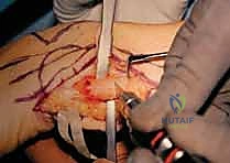 صورة توضيحية لـ عملية سوفيه-كاباندجي: حل متقدم لآلام وعدم استقرار مفصل الرسغ الزندي الكعبري