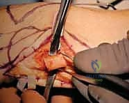 دور الأربطة في استقرار الرسغ