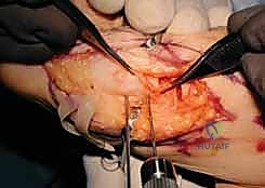 أسباب خشونة المفصل الزندي الكعبري