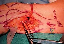 الخيارات الجراحية المختلفة للرسغ