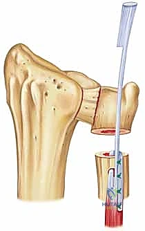 مفهوم عملية سوفيه كاباندجي