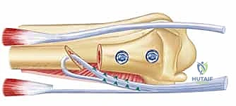 عملية سوفيه-كاباندجي: حل متقدم لآلام وعدم استقرار مفصل الرسغ الزندي الكعبري