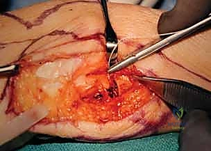 صورة توضيحية لـ عملية سوفيه-كاباندجي: حل متقدم لآلام وعدم استقرار مفصل الرسغ الزندي الكعبري