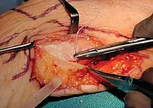 صورة توضيحية لـ عملية سوفيه-كاباندجي: حل متقدم لآلام وعدم استقرار مفصل الرسغ الزندي الكعبري