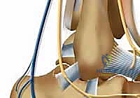 استخدام العكازات والحذاء الطبي الواقي