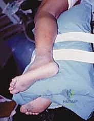 إحداث الثقوب الجراحية الدقيقة