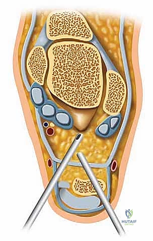 صورة توضيحية لـ منظار مفصل تحت الكاحل: حل شامل لآلام مؤخرة القدم مع الأستاذ الدكتور محمد هطيف