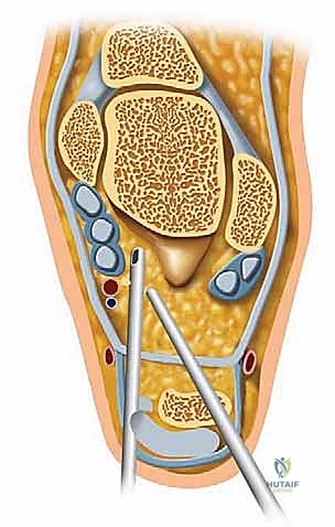 صورة توضيحية لـ منظار مفصل تحت الكاحل: حل شامل لآلام مؤخرة القدم مع الأستاذ الدكتور محمد هطيف