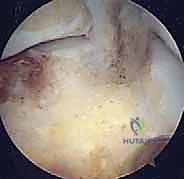 دقة العمليات بالمنظار مقارنة بالجراحة المفتوحة