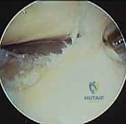 إدخال كاميرا المنظار للتقييم الداخلي