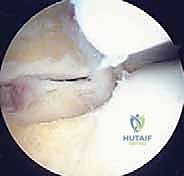 بدء مرحلة التعافي بعد المنظار