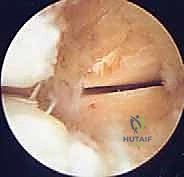 صورة توضيحية لـ منظار مفصل تحت الكاحل: حل شامل لآلام مؤخرة القدم مع الأستاذ الدكتور محمد هطيف