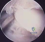 صورة توضيحية لـ منظار مفصل تحت الكاحل: حل شامل لآلام مؤخرة القدم مع الأستاذ الدكتور محمد هطيف