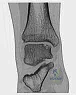 فحص سريري للكاحل لتحديد مكان الألم