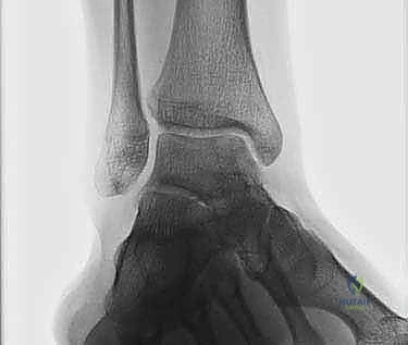 صورة توضيحية للتروية الدموية في الكاحل