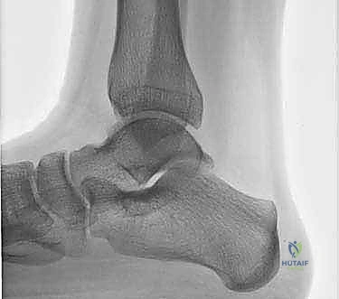 التآكل الغضروفي غير الرضي