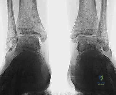 تأثير الالتواء الشديد على غضروف الكاحل