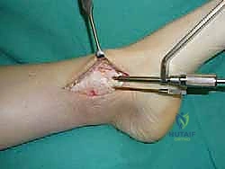 تخطيط العلاج بناءً على موقع الآفة