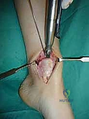 صورة توضيحية لـ علاج آفات القبة الكاحلية العظمية الغضروفية بالزرع الذاتي: خبرة الأستاذ الدكتور محمد هطيف في صنعاء