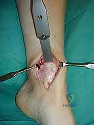 صورة توضيحية لـ علاج آفات القبة الكاحلية العظمية الغضروفية بالزرع الذاتي: خبرة الأستاذ الدكتور محمد هطيف في صنعاء