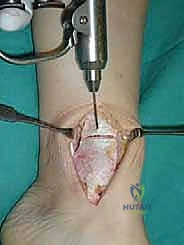 التنظيف بالمنظار للكاحل