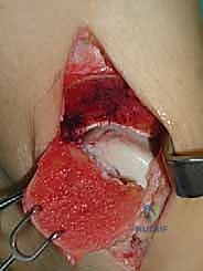 صورة توضيحية لـ علاج آفات القبة الكاحلية العظمية الغضروفية بالزرع الذاتي: خبرة الأستاذ الدكتور محمد هطيف في صنعاء