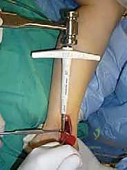 صورة طبية: علاج آفات القبة الكاحلية العظمية الغضروفية بالزرع الذاتي: خبرة الأستاذ الدكتور محمد هطيف في صنعاء