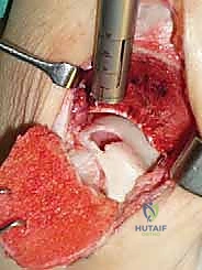 صورة توضيحية لـ علاج آفات القبة الكاحلية العظمية الغضروفية بالزرع الذاتي: خبرة الأستاذ الدكتور محمد هطيف في صنعاء