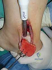 صورة توضيحية لـ علاج آفات القبة الكاحلية العظمية الغضروفية بالزرع الذاتي: خبرة الأستاذ الدكتور محمد هطيف في صنعاء