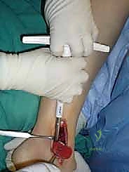 صورة طبية: علاج آفات القبة الكاحلية العظمية الغضروفية بالزرع الذاتي: خبرة الأستاذ الدكتور محمد هطيف في صنعاء