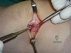 صورة طبية: علاج آفات القبة الكاحلية العظمية الغضروفية بالزرع الذاتي: خبرة الأستاذ الدكتور محمد هطيف في صنعاء