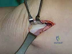 صورة طبية: علاج آفات القبة الكاحلية العظمية الغضروفية بالزرع الذاتي: خبرة الأستاذ الدكتور محمد هطيف في صنعاء