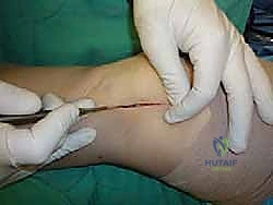 صورة طبية: علاج آفات القبة الكاحلية العظمية الغضروفية بالزرع الذاتي: خبرة الأستاذ الدكتور محمد هطيف في صنعاء