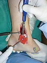 صورة طبية: علاج آفات القبة الكاحلية العظمية الغضروفية بالزرع الذاتي: خبرة الأستاذ الدكتور محمد هطيف في صنعاء