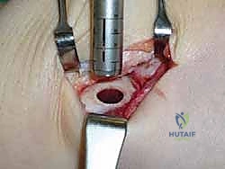 صورة طبية: علاج آفات القبة الكاحلية العظمية الغضروفية بالزرع الذاتي: خبرة الأستاذ الدكتور محمد هطيف في صنعاء