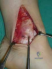 صورة طبية: علاج آفات القبة الكاحلية العظمية الغضروفية بالزرع الذاتي: خبرة الأستاذ الدكتور محمد هطيف في صنعاء