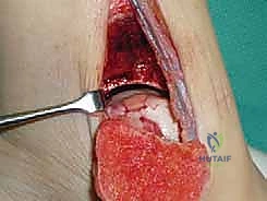 صورة طبية: علاج آفات القبة الكاحلية العظمية الغضروفية بالزرع الذاتي: خبرة الأستاذ الدكتور محمد هطيف في صنعاء