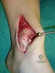 صورة طبية: علاج آفات القبة الكاحلية العظمية الغضروفية بالزرع الذاتي: خبرة الأستاذ الدكتور محمد هطيف في صنعاء